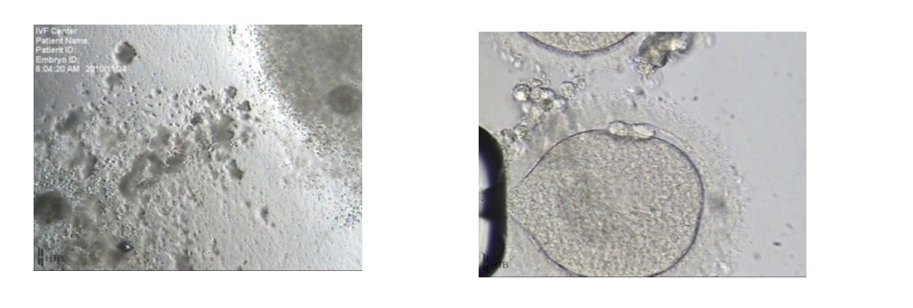 Figure 4. On the left, note the cumulus on the left has clumpy and degenerating appearance compared to the one on the right. On the right, a post-mature oocyte from the degenerating oocyte-cumulus complex on the left (Dozortsev, unpublished)